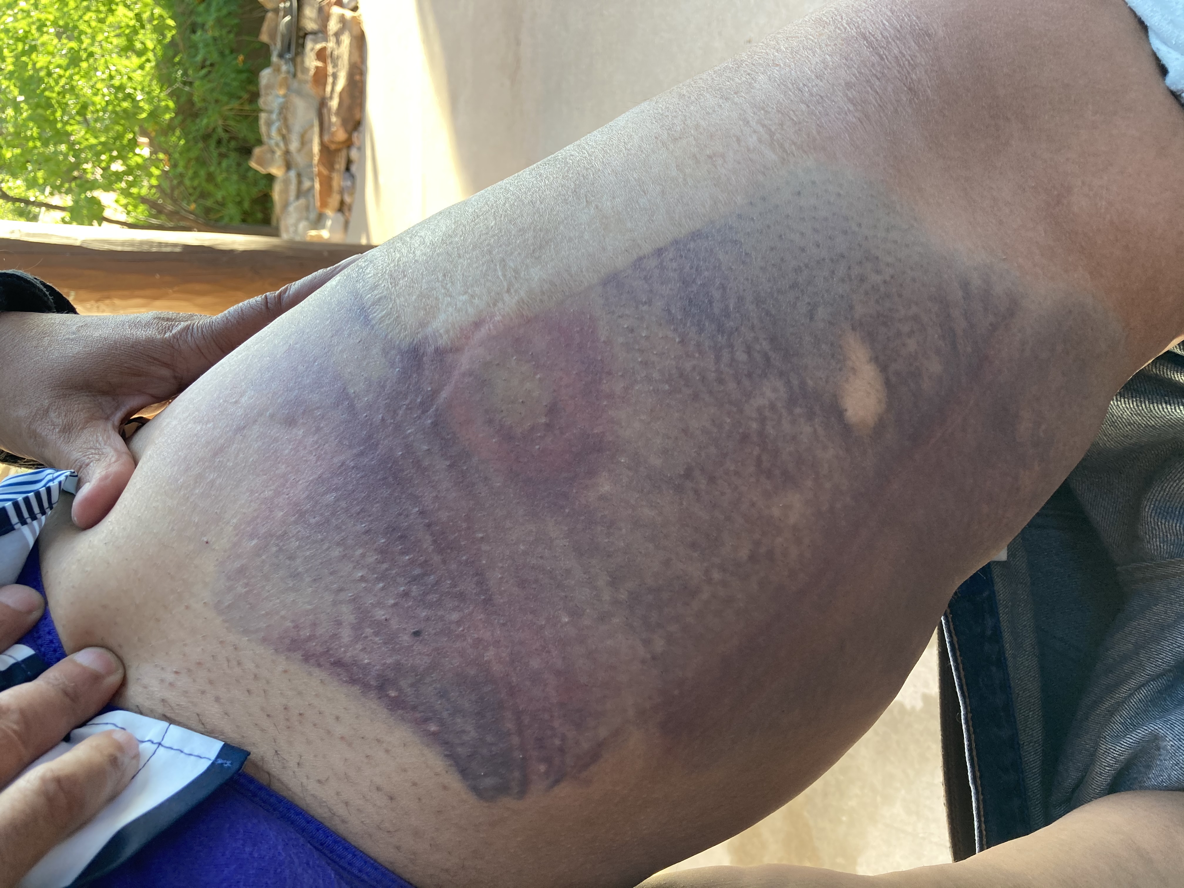 Bruise on the thigh of 'Selina Kyle' from a special impact munition. An officer fired on her at a distance of about five feet while her hands were up She said he smirked afterwards.