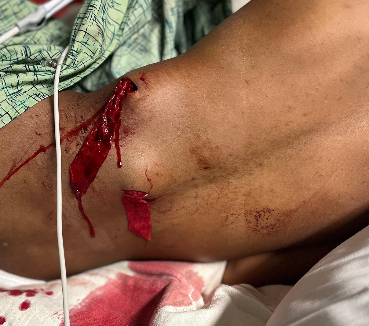 An adolescent’s back is seen as the victim lays on their side in a hospital bed. Her wounds are packed with gauze and bleeding.